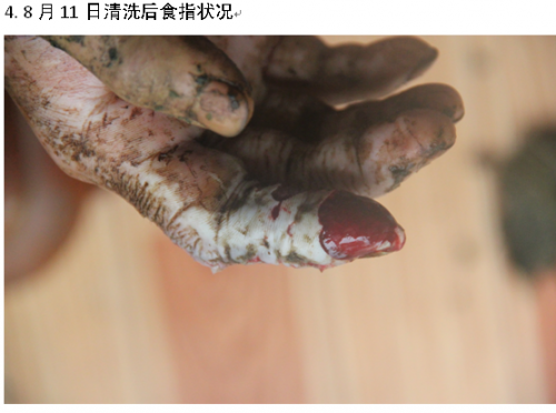 杨海江蛇伤8.13.png