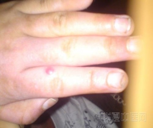 手背好了.jpg