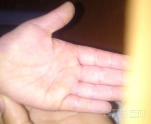 手心好了.jpg